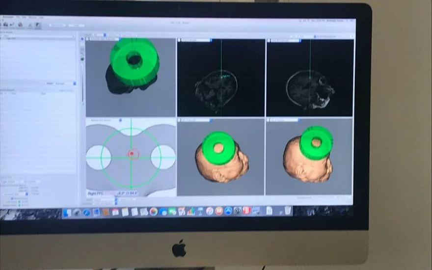 Μεγάλη διάκριση για Ελληνίδα επιστήμονα: Επικεφαλής της πρώτης επέμβασης με χρήση υπερήχων σε ασθενή με Αλτσχάιμερ