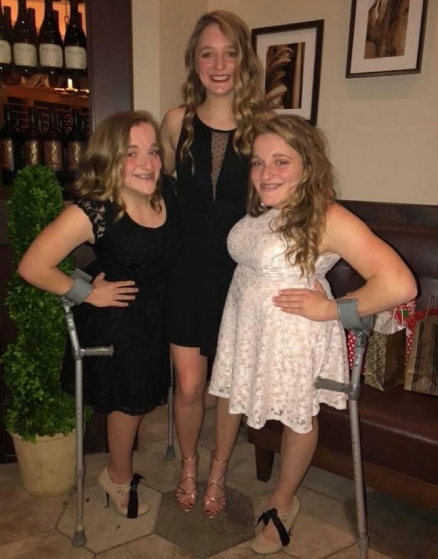 Οι σιαμαίες δίδυμες που γεννήθηκαν το 2003, χειρουργήθηκαν για 24 ώρες και σήμερα είναι 2 όμορφες κοπέλες που ζουν ανεξάρτητα