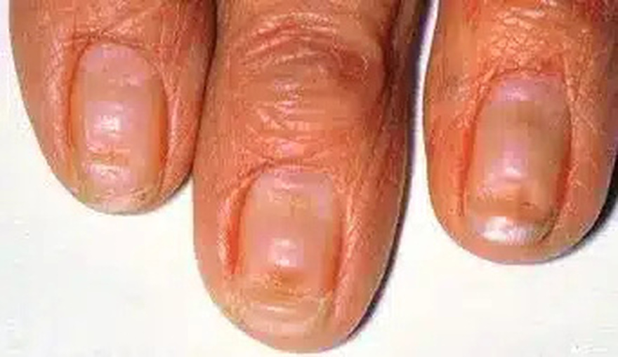 Γραμμές στα νύχια: Δείτε τι σημαίνουν μέσα από φωτογραφίες