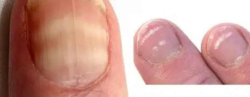 Γραμμές στα νύχια: Δείτε τι σημαίνουν μέσα από φωτογραφίες