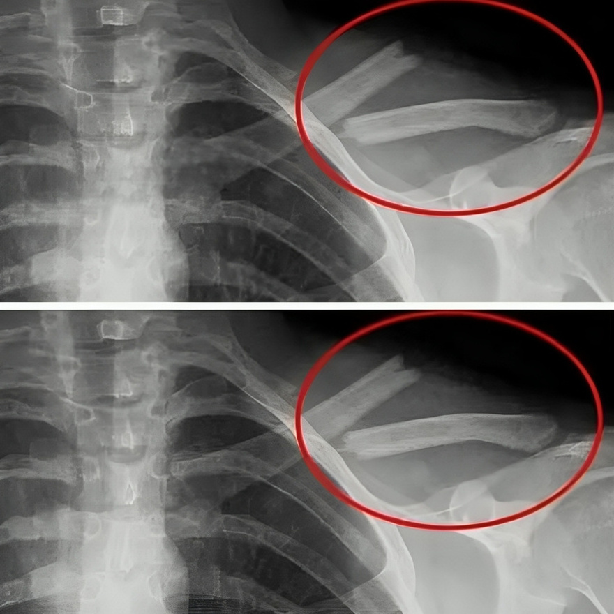 Auτό το ποτό θα καταστρέψει τα κόκαλα σας από μέσα αλλά όλοι το πίνουν