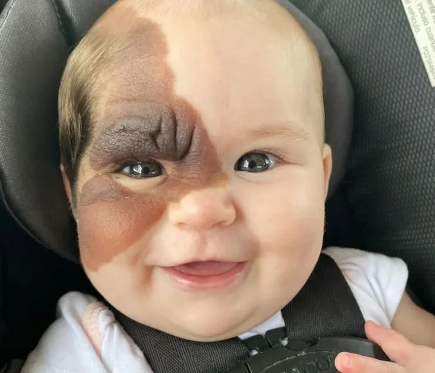 Μητέρα συγκινεί: «Η κόρη μου γεννήθηκε με σπάνιο εκ γενετής σημάδι κι είναι πανέμορφη»