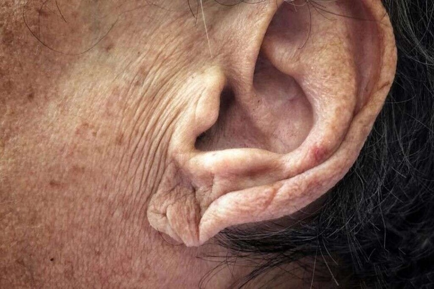 Φραγμένες αρτηρίες: Τα «ύπουλα» συμπτώματα που δεν πρέπει να αγνοούμε