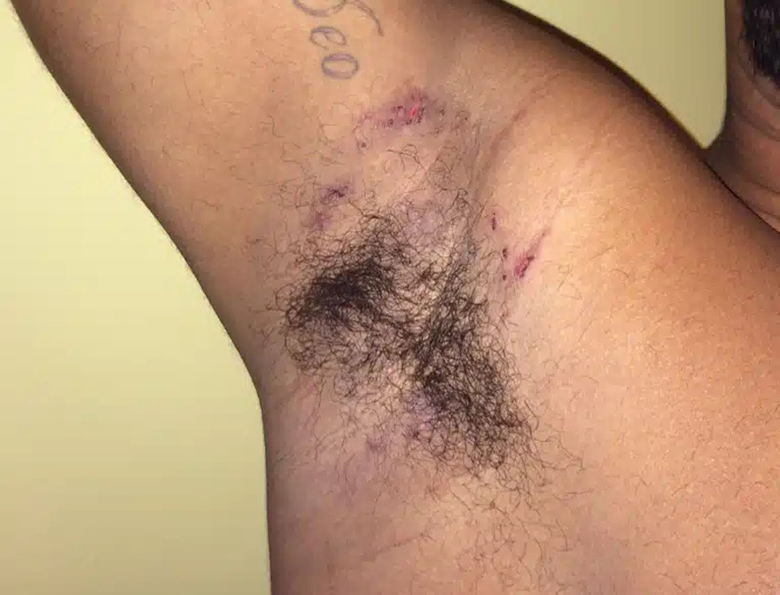 Εκεί που έκανε μπάνιο, ένιωσε κάτι να τον καίει κάτω από τη μασχάλη. Δεν ήταν όμως το σαπούνι…