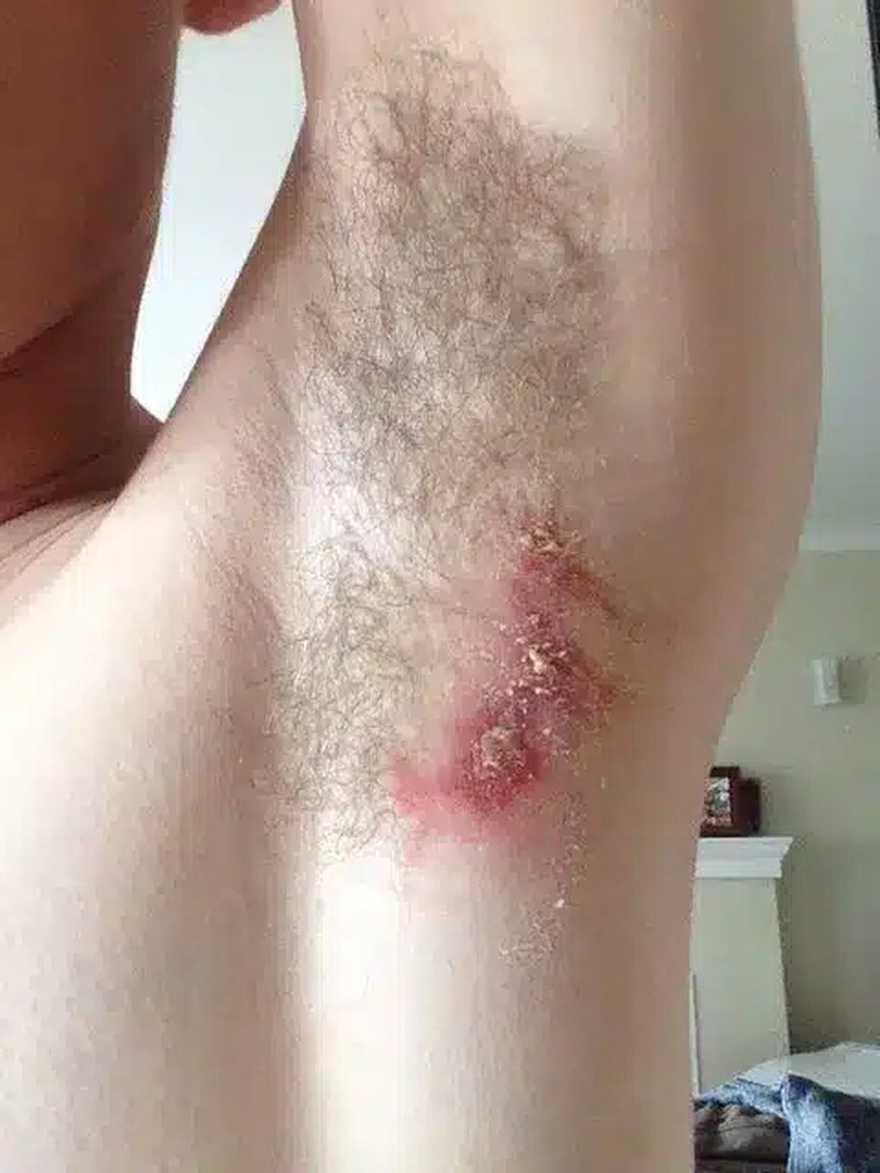 Εκεί που έκανε μπάνιο, ένιωσε κάτι να τον καίει κάτω από τη μασχάλη. Δεν ήταν όμως το σαπούνι…