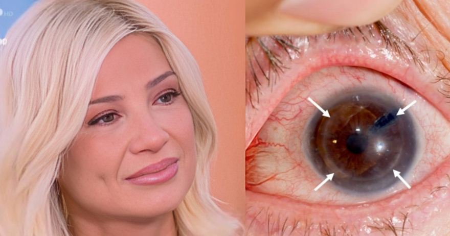 Φαίη Σκορδά: Τι είναι ο κερατόκωνος με τον οποίο έχει διαγνωσθεί – Συμπτώματα, αιτίες και διάγνωση