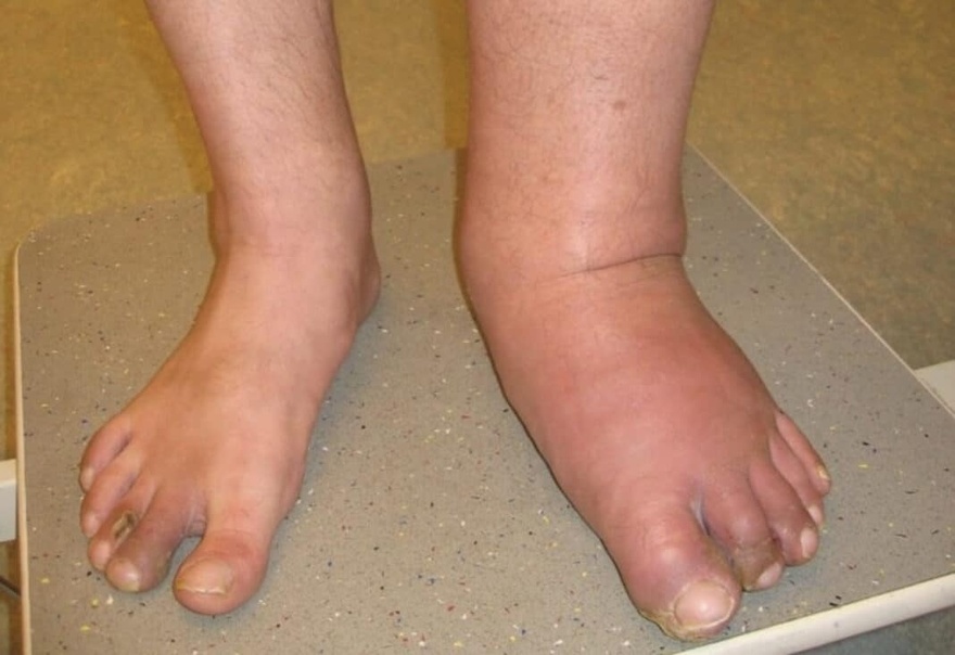 Ξεκάθαρα συμπτώματα ότι αυτό είναι…