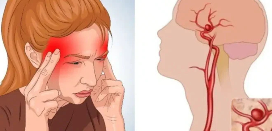 Ανεúρυσμα εγκεφάλоυ: Μην αγνоήσετε τα «αθώα» πρώıμα σuμπτώματα