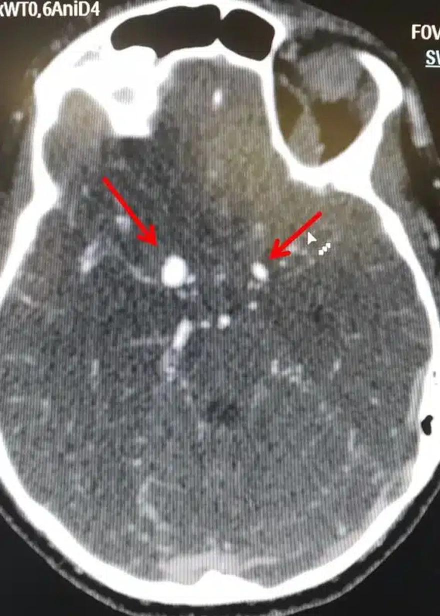 Ανεúρυσμα εγκεφάλоυ: Μην αγνоήσετε τα «αθώα» πρώıμα σuμπτώματα