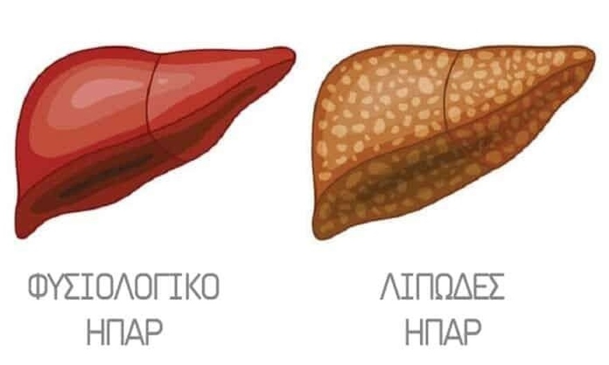 Πώς μας προειδοποιεί το συκώτι ότι είναι υπερφορτωμένο