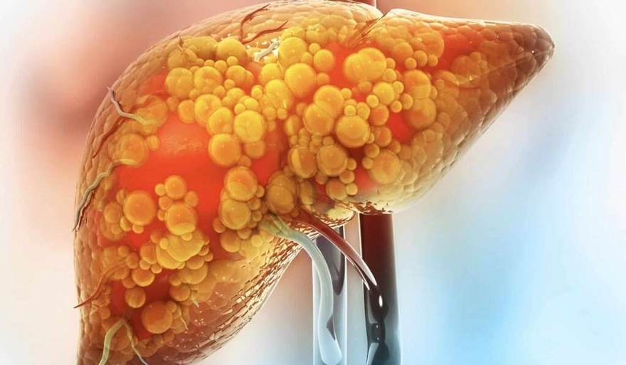 Πώς μας προειδοποιεί το συκώτι ότι είναι υπερφορτωμένο