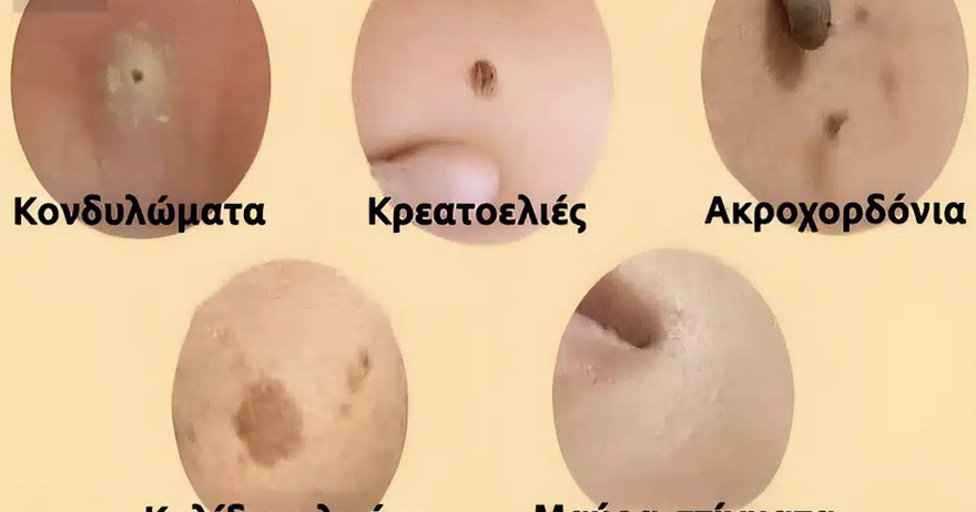 Αντιμετωπίστε φυσικά κηλίδες, κρεατοελιές, μυρμηγκιές και μαύρα στίγματα
