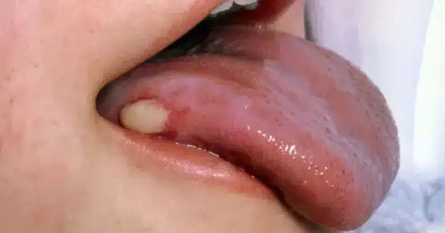 Συναγερμός από τους επιστήμονες για όσους και όσες κάνουν στοματικό έpωτα