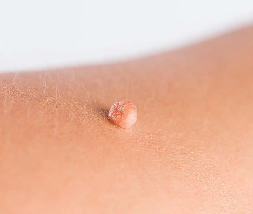 Αντιμετωπίστε φυσικά κηλίδες, κρεατοελιές, μυρμηγκιές και μαύρα στίγματα